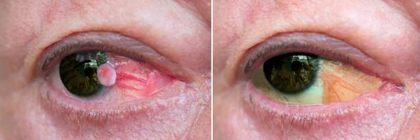 Close up of the eye with carcinoma Close up of the eye with conjunctiva squamous cell carcinoma before and one year after surgigal removal. Postsurgery pseudopterygium squamous cell carcinoma photos stock pictures, royalty-free photos & images