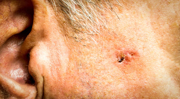 rak podstawnokomórkowy na twarzy starszego mężczyzny przed operacją - zbliżenie - human eye men close up macro zdjęcia i obrazy z banku zdjęć