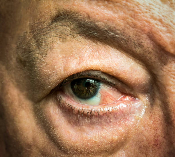 Close up of the eye with pseudopterygium Close up of the eye with pseudopterygium after one year of conjunctiva squamous cell carcinoma surgical removal squamous cell carcinoma photos stock pictures, royalty-free photos & images
