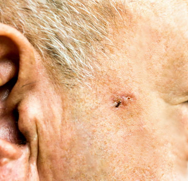 basaliom på framsidan äldre man innan operationen - närbild - basalcellscancer bildbanksfoton och bilder