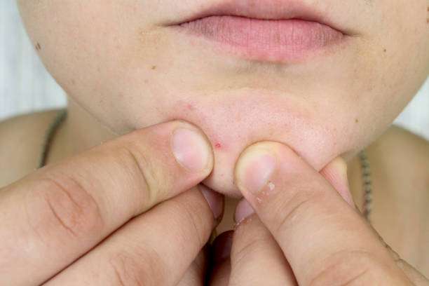 Man squeezes his fingers with a pimple on his chin. Problem Skin. Men's pimple treatment before after image, acne treatment, men's skin care. man squeezes a pimple with his hands. Face hygiene. tratamiento de grano de los hombres antes de después de imagen, tratamiento del acné, cuidado de la piel de los hombres. hombre exprime una espinilla con las manos. higiene de la cara. hombre aprieta los dedos con un grano en la barbilla. piel del problema