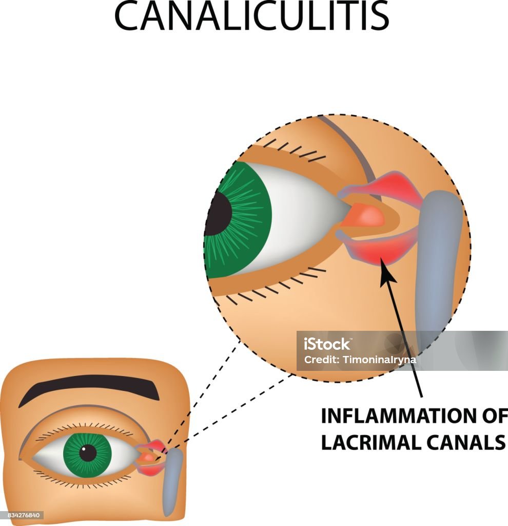 Canaliculitis. Inflammation of lacrimal canals. The structure of the eye. Infographics. Vector illustration on isolated background Canaliculitis. Inflammation of lacrimal canals. The structure of the eye. Infographics. Vector illustration on isolated background. Lacrimal Gland stock vector