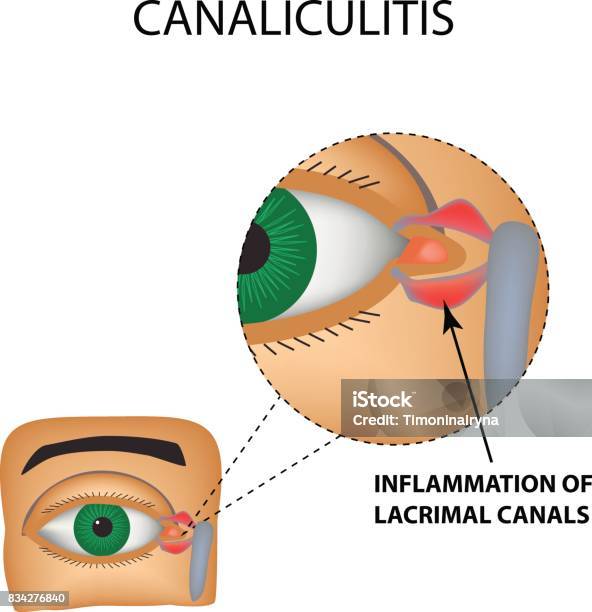 Canaliculitis Inflammation Of Lacrimal Canals The Structure Of The Eye Infographics Vector Illustration On Isolated Background Stock Illustration - Download Image Now