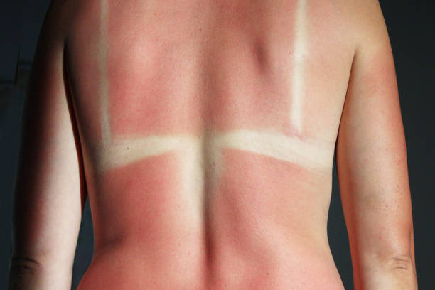 istock Burn from the sun on the body 834799180