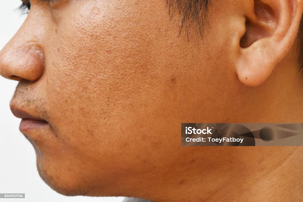 pores and oily on surface young asian man face skin do not take care for a long time Acne Stock Photo