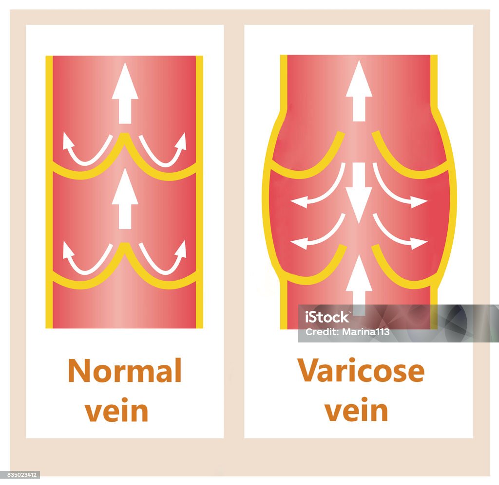 The varicose veins and normal veins The abstract varicose veins and normal veins Varicose Vein stock illustration