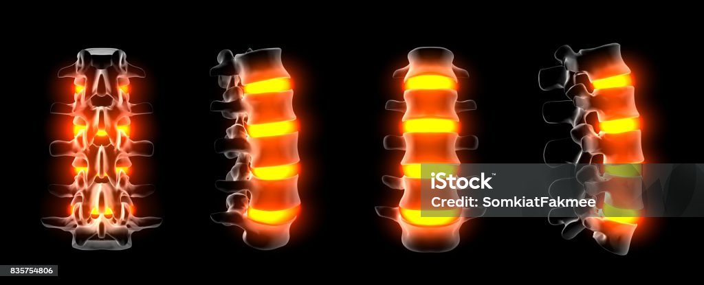 3d rendering of spine structure on black background Hernia Stock Photo