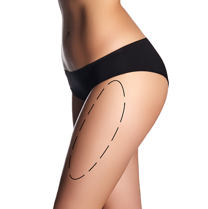 Liposuction lines on a woman's body. Sexy body of a beautiful woman. Beautiful woman body. Perfect shining skin for summer