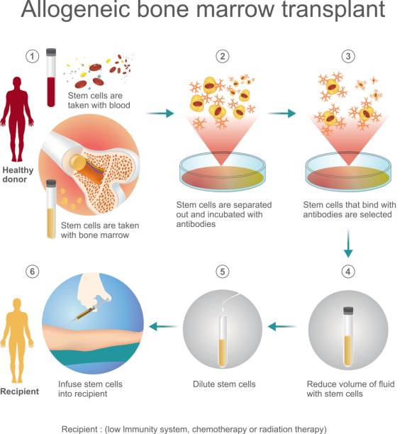 The allogeneic transplant process. The allogeneic transplant process are donated to the person from another person, a genetically matched stem cell donor. Info graphic vector. stem cell illustrations stock illustrations