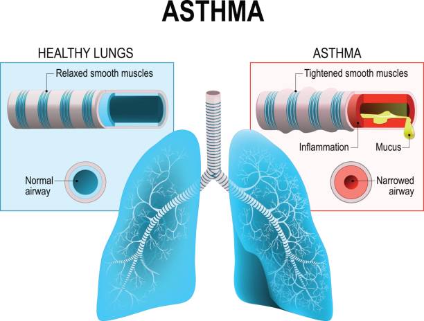 Asthma Asthma is a chronic inflammatory disease of the airways that is characterized by narrowing of the airways bronchospasm and coughing. Humans lungs and bronchi biomedical illustration stock illustrations