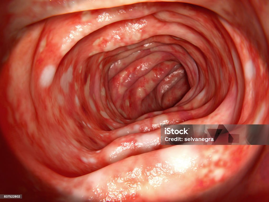 Colon affected by ulcerative colitis The ulcerative colitis is an inflammatory disease of the human bowel. Endoscope Stock Photo