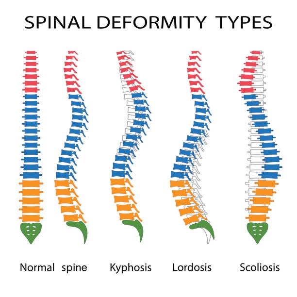 Spinal deformity types. Illustration of spinal deformity types. Kyphosis, lordosis and scoliosis. deformed stock illustrations