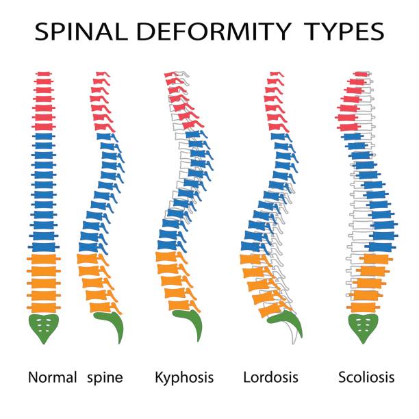 Spinal deformity types. Illustration of spinal deformity types. Kyphosis, lordosis and scoliosis. kyphosis stock illustrations