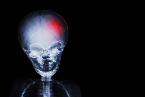 accident vasculaire cérébral. film x-ray crâne et corps d’enfant avec la couleur rouge à tête. neurologique concept - neurologic photos et images de collection