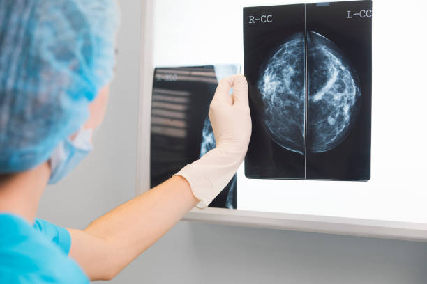 medico donna o infermiera in abito chirurgico è in possesso di una mammografia di fronte all'illuminatore a raggi x - macchina per radiografie foto e immagini stock