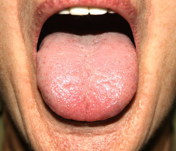 istock Candidiasis in the tongue. White coating. Thrush. 839441110