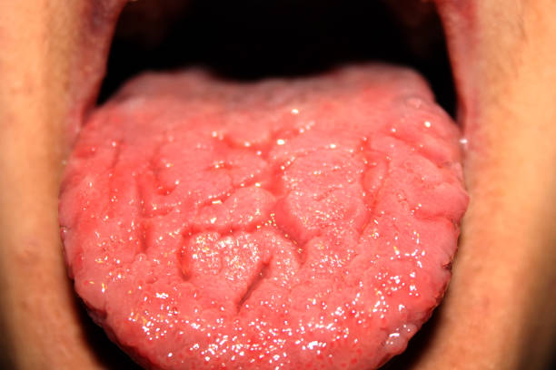 istock Candidiasis in the tongue. White coating. Thrush. 839973194