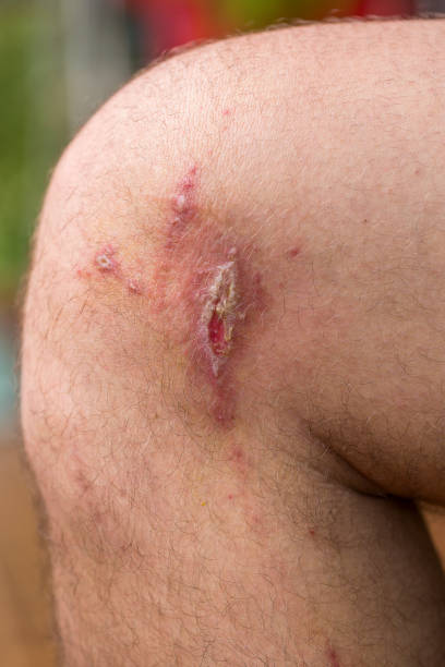 istock Irritant contact dermatitis at man leg, close up. 840064628
