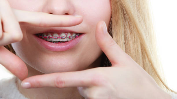 istock Happy woman showing her braces on teeth 840086816