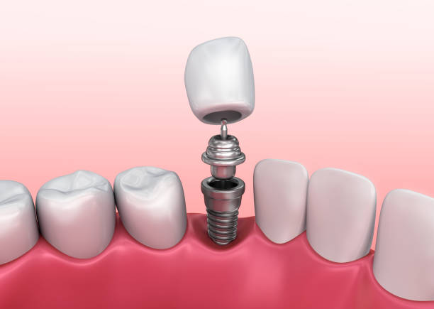 istock Tooth implant instalation process , Medically accurate 3D illustration white style 840118012