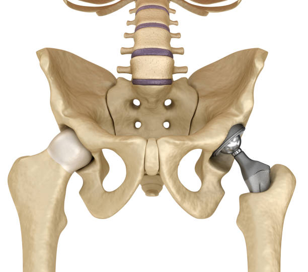 hüftgelenkersatz-implantat in den knochen des beckens installiert. medizinisch genaue 3d-illustration - hip replacement stock-fotos und bilder