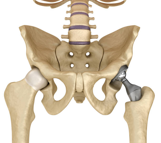 힙합 교체 이식 골반 뼈에 설치입니다. 의학적으로 정확한 3d 그림 - hip replacement 뉴스 사진 이미지