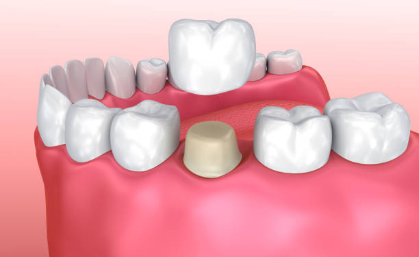 processo di installazione della corona dentale, illustrazione 3d medicalmente accurata - hebrides foto e immagini stock