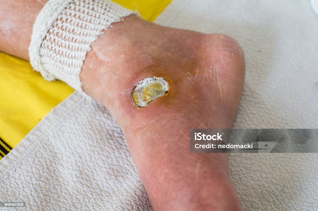 Diabetic Foot Diabetic Foot. Wound Stock Photo