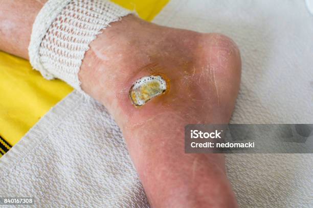 Diabetic Foot Stock Photo - Download Image Now - Wound, Care, Foot