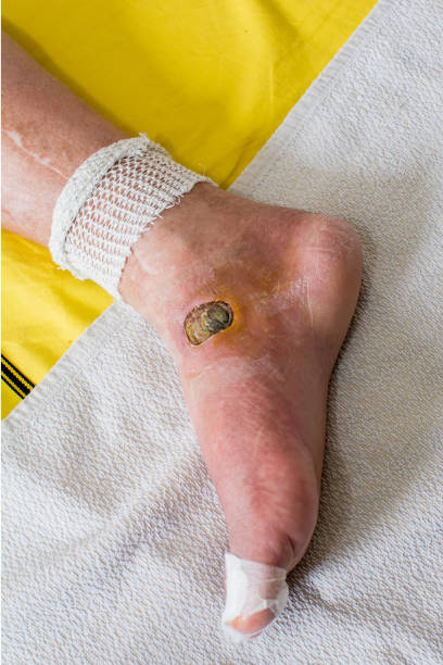 piede diabetico - human foot diabetes ulcer senior adult foto e immagini stock