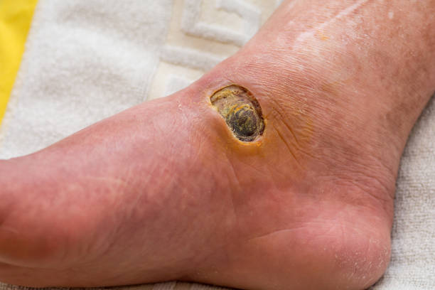 diabetische fuß - human foot diabetes ulcer senior adult stock-fotos und bilder