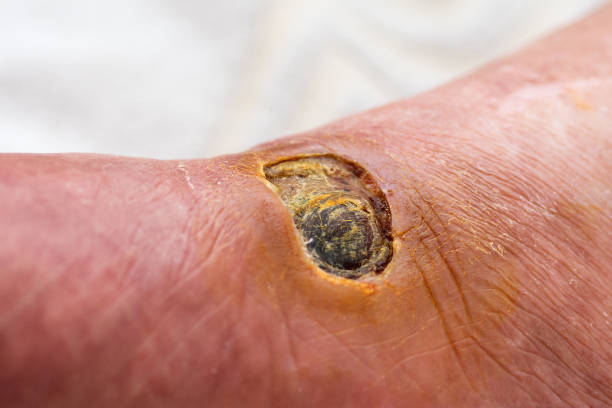piede diabetico - human foot diabetes ulcer senior adult foto e immagini stock