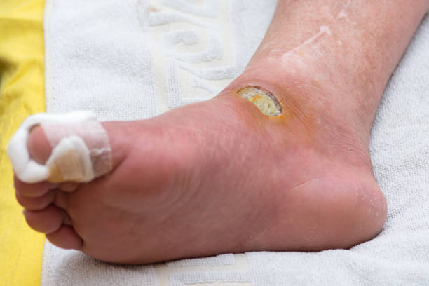 diabetische fuß - human foot diabetes ulcer senior adult stock-fotos und bilder