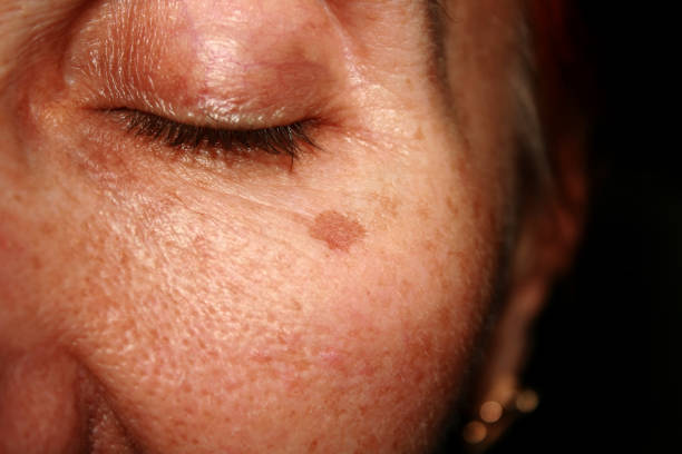 istock Brown spots under the eye. Pigmentation on the face 840651360
