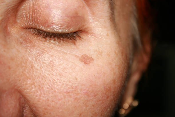 istock Brown spots under the eye. Pigmentation on the face 840651404