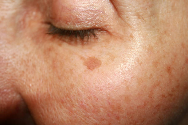 istock Brown spots under the eye. Pigmentation on the face 840651426