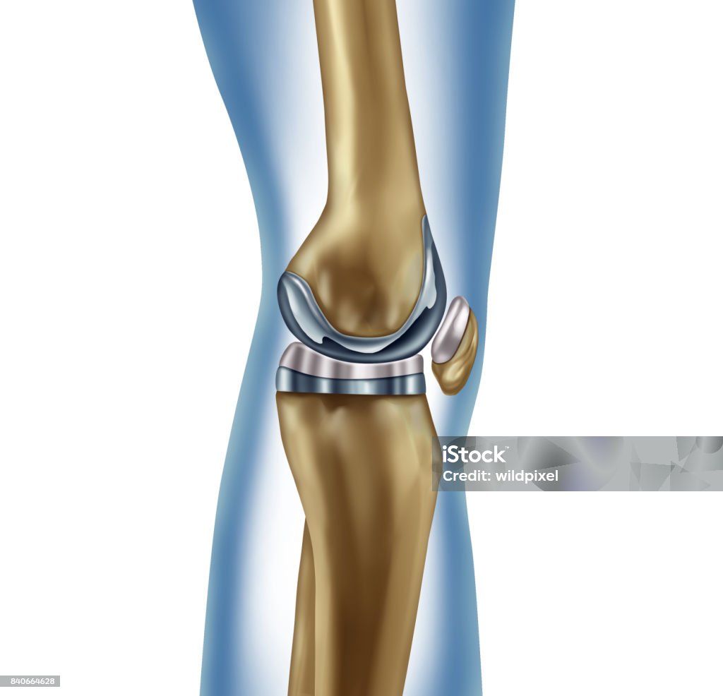 Replacement Knee Replacement knee implant medical concept as a human leg anatomy after a prosthetic surgery as a musculoskeletal disease treatment symbol for orthopedics with 3D illustration elements on white. Artificial Knee Stock Photo