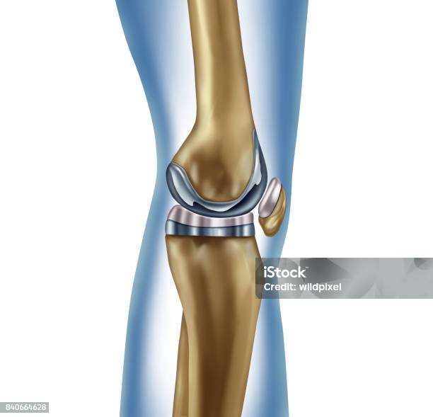 Replacement Knee Stock Photo - Download Image Now - Artificial Knee, Implant, Healthcare And Medicine