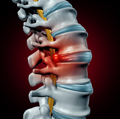 Human herniated disk concept and spine pain diagnostic as a human spinal system symbol as medical health problem and anatomy symbol with the skeletal bone structure and intervertebral discs closeup as a 3D illustration.