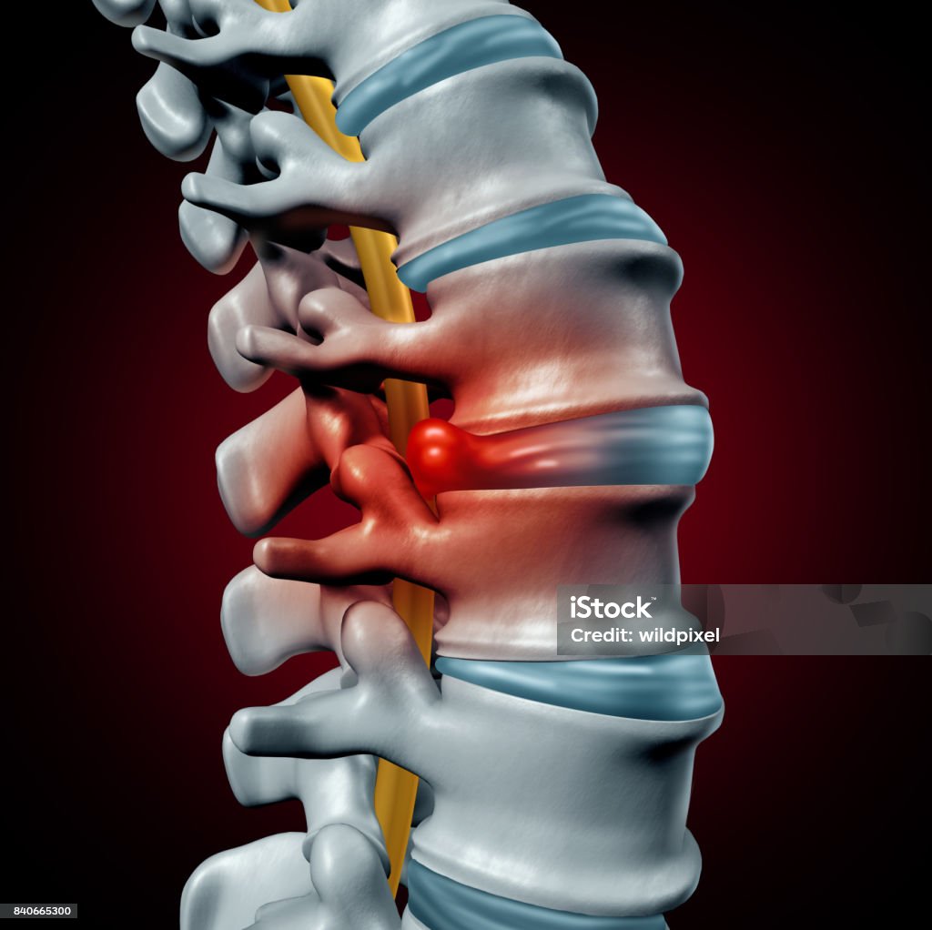 Human Herniated Disk Human herniated disk concept and spine pain diagnostic as a human spinal system symbol as medical health problem and anatomy symbol with the skeletal bone structure and intervertebral discs closeup as a 3D illustration. Herniated Disc Stock Photo