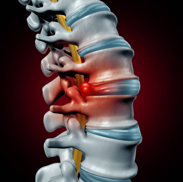 humanos hérnia de disco - human spine human vertebra disk spinal - fotografias e filmes do acervo