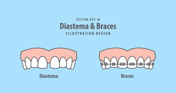 diastema & hosenträger illustration vektor auf blauem hintergrund. dental konzept. - beißring stock-grafiken, -clipart, -cartoons und -symbole