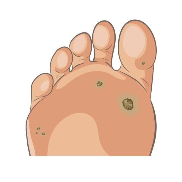 Foot wart. Foot bottom pathology: verruca, wart, papilloma virus. Many small warts on the sole and toe. Foot wart. Foot bottom pathology: verruca, wart, papilloma virus. Many small warts on the sole and toe. Male or female sole, barefoot. Cartoon style, hand drawn. Vector illustration isolated on white. high heel footprint stock illustrations