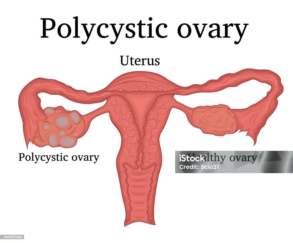 Illustration des PCO - Lizenzfrei Polyzystisches Ovar-Syndrom Vektorgrafik