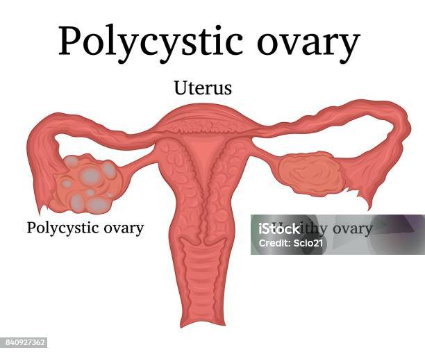 Illustration Des Pco Stock Vektor Art und mehr Bilder von Polyzystisches Ovar-Syndrom - Polyzystisches Ovar-Syndrom, Krankheit, Eierstock