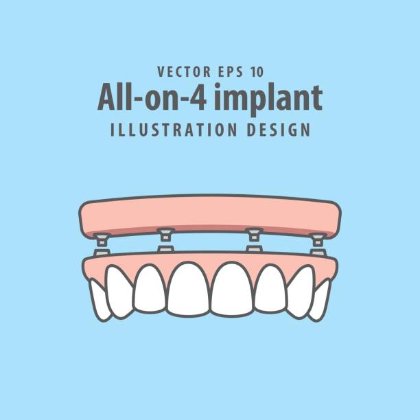 모든-에-4 파란색 배경에 그림 벡터 이식. 치과 개념입니다. - prosthetic equipment illustrations stock illustrations