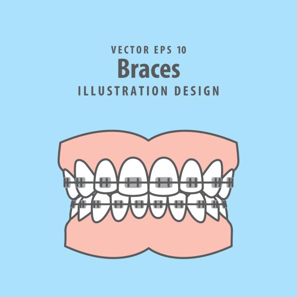 Braces teeth(full) illustration vector on blue background. Dental concept. Braces teeth(full) illustration vector on blue background. Dental concept. orthodontist stock illustrations