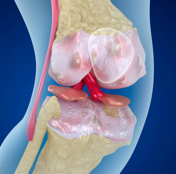 istock Osteoporosis of the knee joint,  Medically accurate 3D illustration 841091032