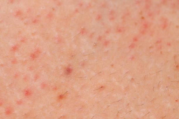 istock Folliculitis on female skin 841557404
