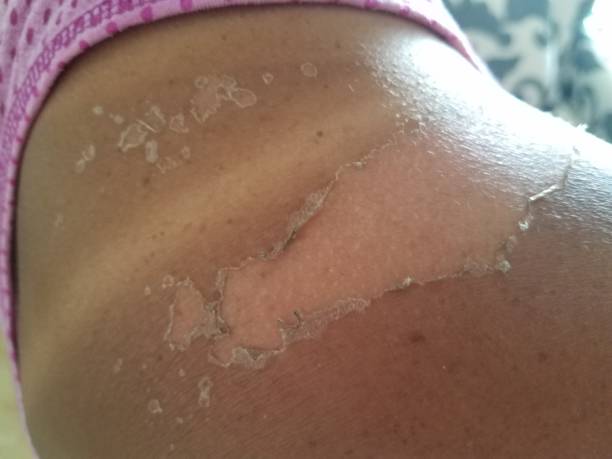istock a sun burn and peeling skin on a woman's shoulder 841571018